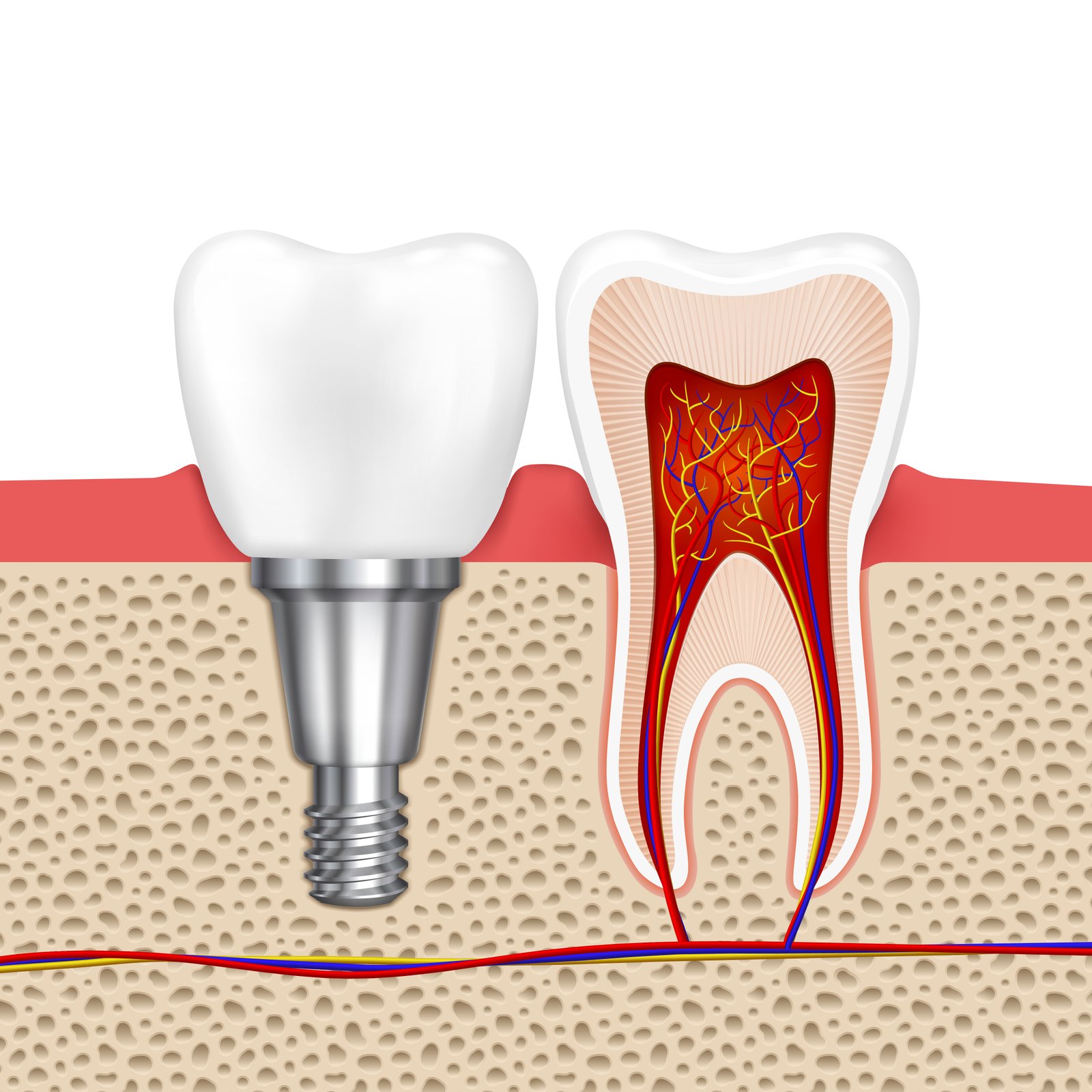 Dental Implant Crown